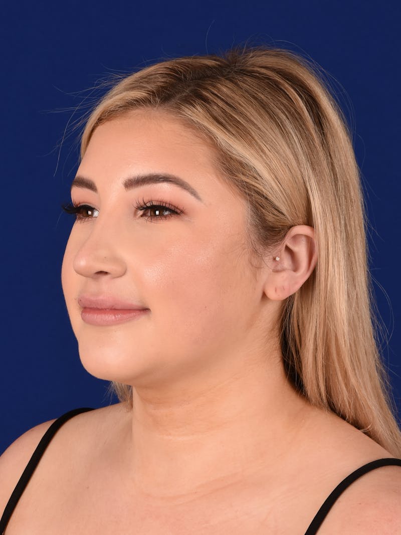 Female Rhinoplasty Before & After Gallery - Patient 17363940 - Image 4