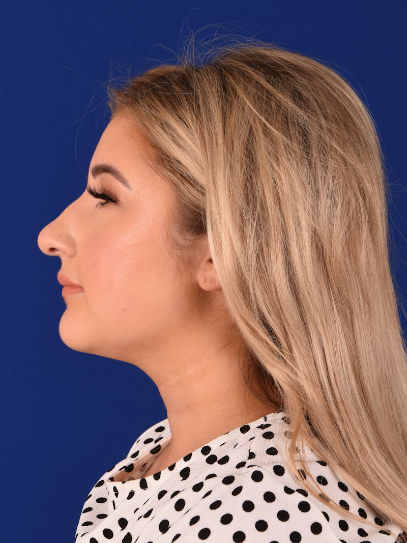 Female Rhinoplasty Before & After Gallery - Patient 17363940 - Image 5