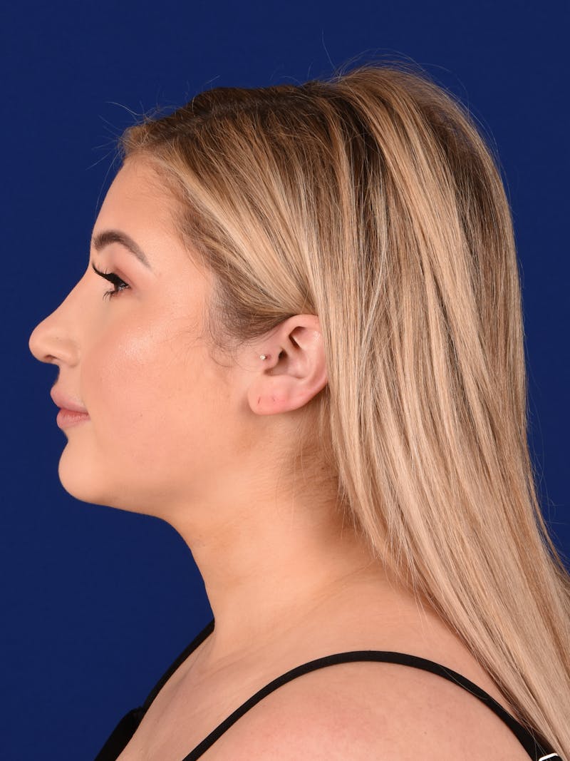 Female Rhinoplasty Before & After Gallery - Patient 17363940 - Image 6