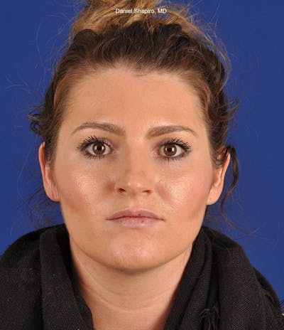 Female Rhinoplasty Before & After Gallery - Patient 17363943 - Image 1