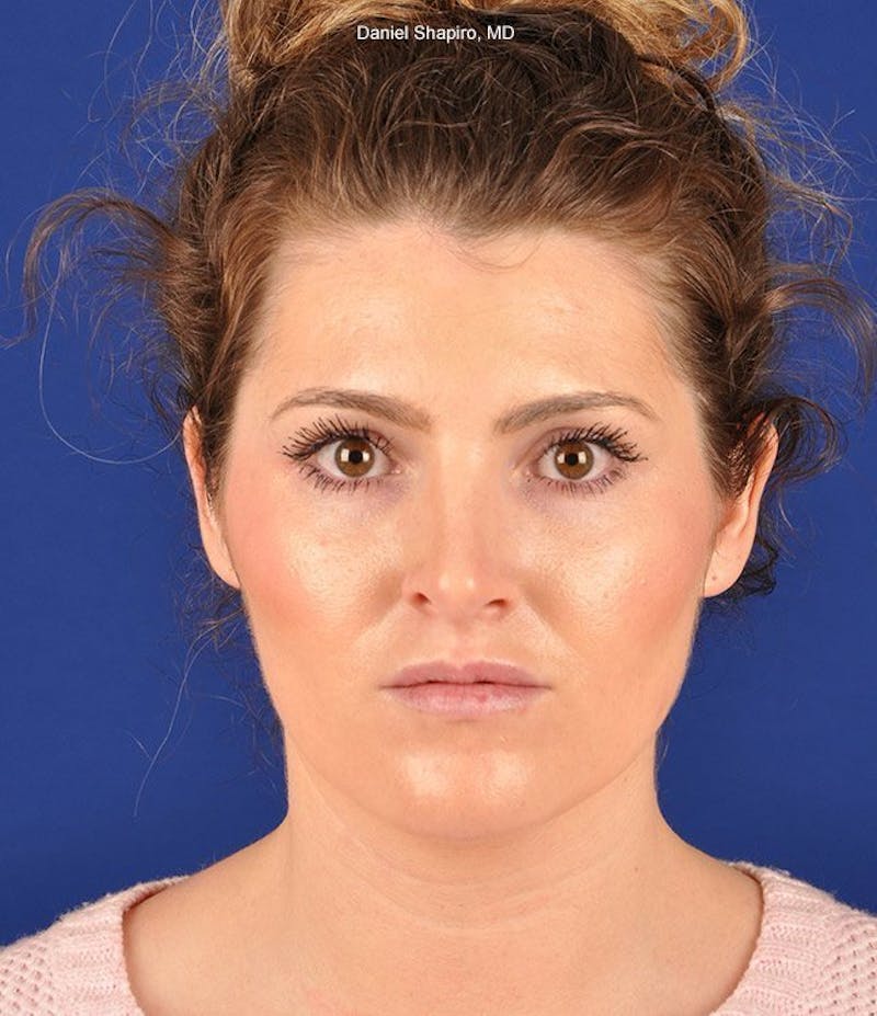 Female Rhinoplasty Before & After Gallery - Patient 17363943 - Image 2
