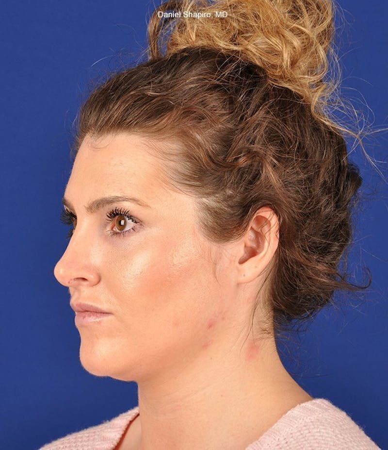 Female Rhinoplasty Before & After Gallery - Patient 17363943 - Image 4