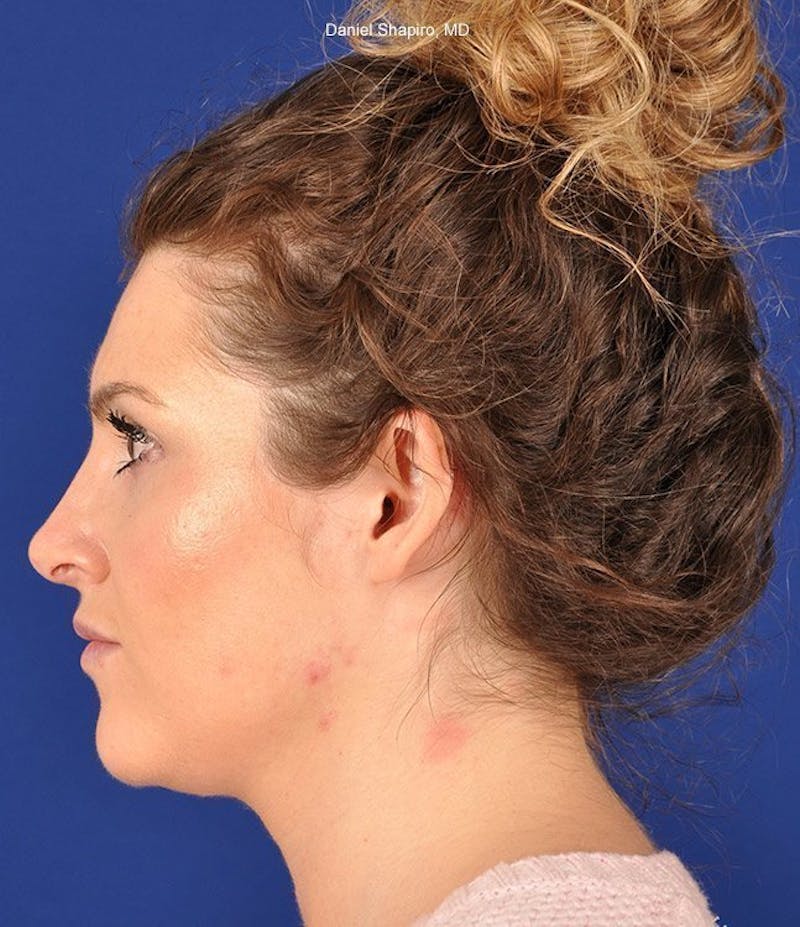 Female Rhinoplasty Before & After Gallery - Patient 17363943 - Image 6