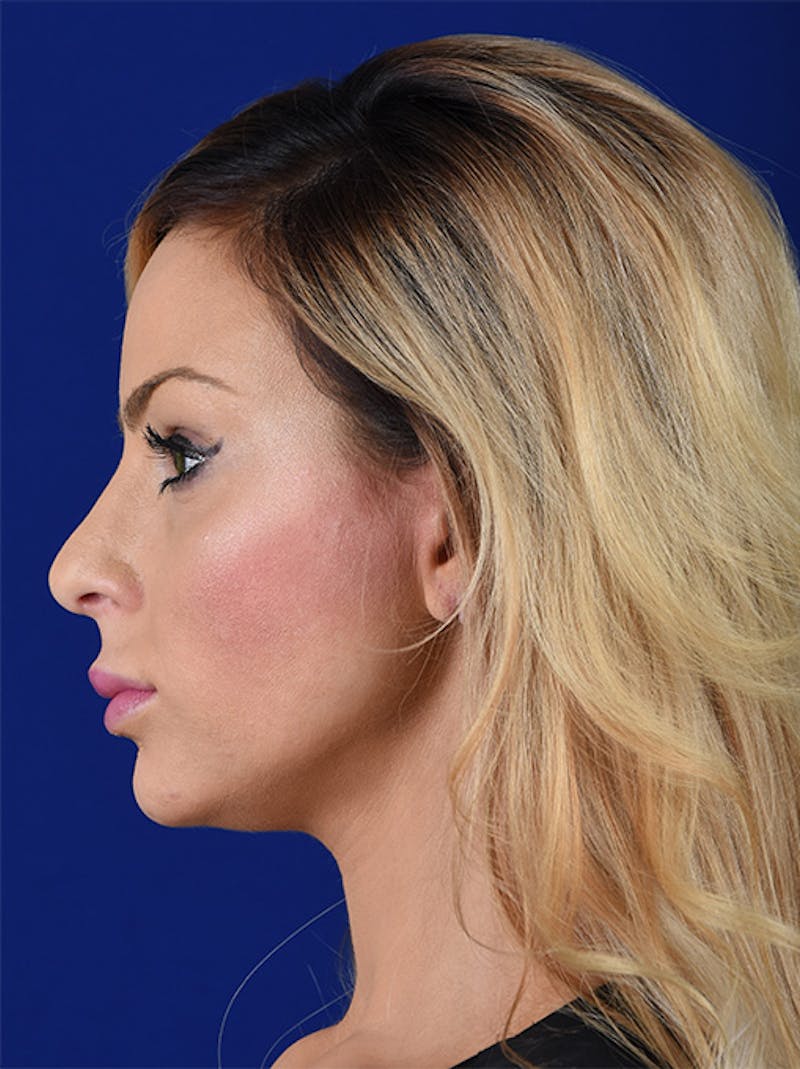 Female Rhinoplasty Before & After Gallery - Patient 17363948 - Image 5