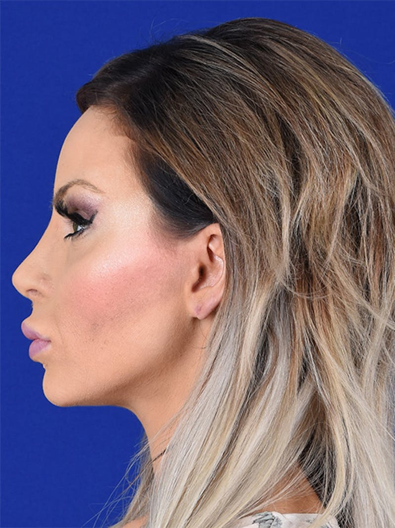 Female Rhinoplasty Before & After Gallery - Patient 17363948 - Image 6