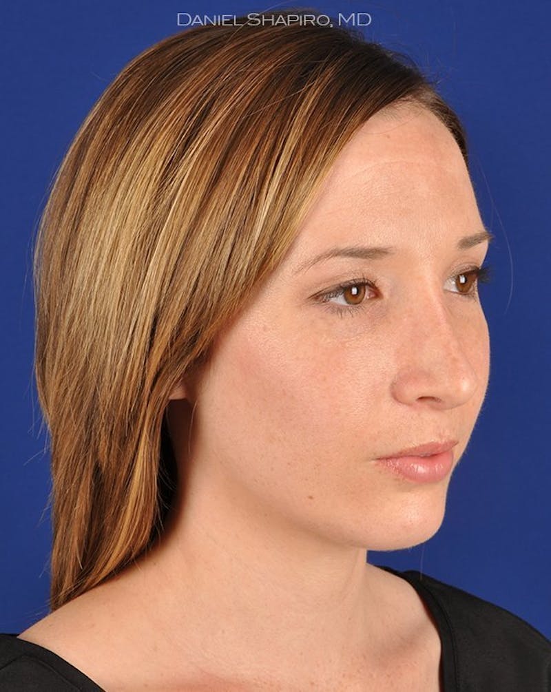 Female Rhinoplasty Before & After Gallery - Patient 17363949 - Image 4