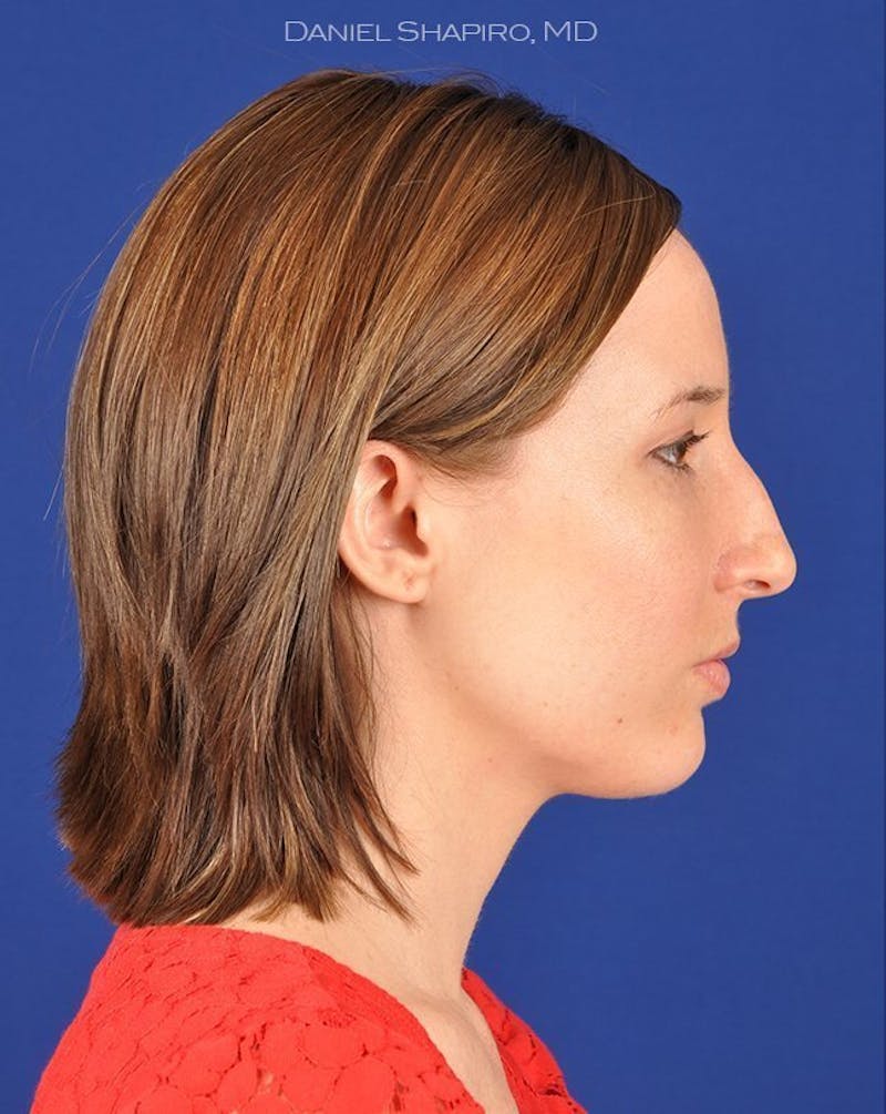 Female Rhinoplasty Before & After Gallery - Patient 17363949 - Image 5