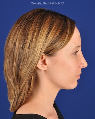 Female Rhinoplasty Before & After Gallery - Patient 17363949 - Image 6