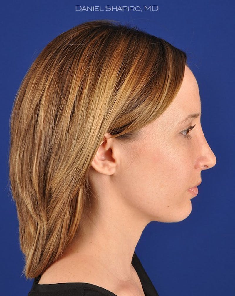 Female Rhinoplasty Before & After Gallery - Patient 17363949 - Image 6