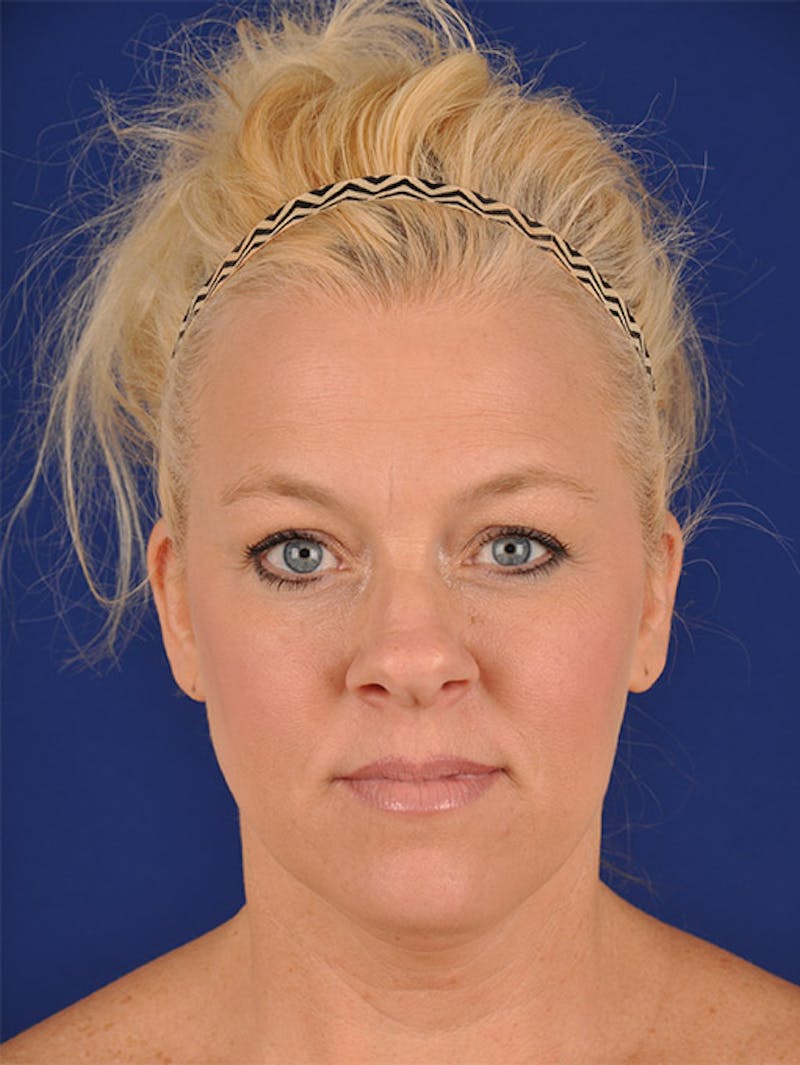 Female Rhinoplasty Before & After Gallery - Patient 17363951 - Image 1