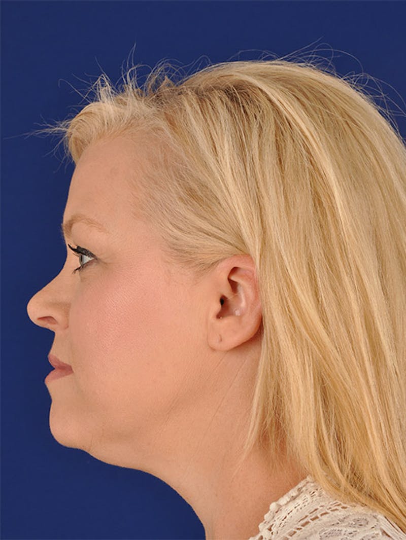 Female Rhinoplasty Before & After Gallery - Patient 17363951 - Image 6