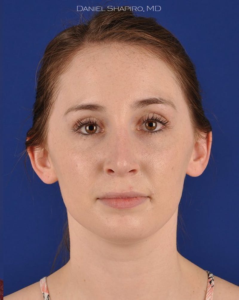 Female Rhinoplasty Before & After Gallery - Patient 17363952 - Image 2