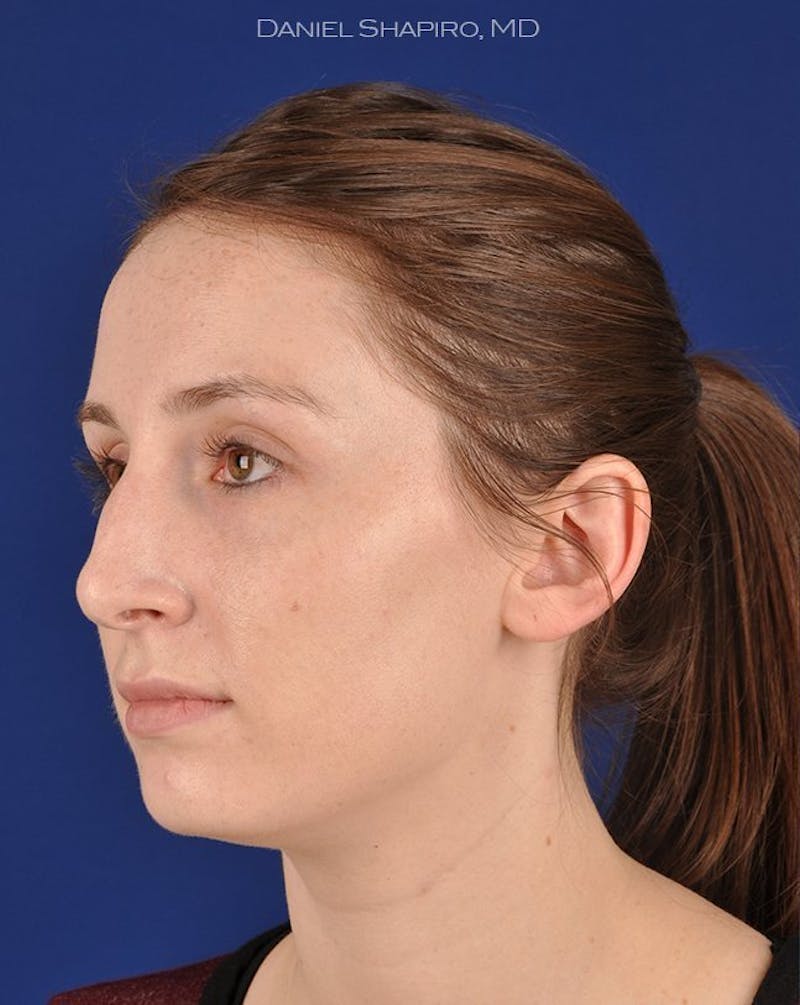 Female Rhinoplasty Before & After Gallery - Patient 17363952 - Image 3