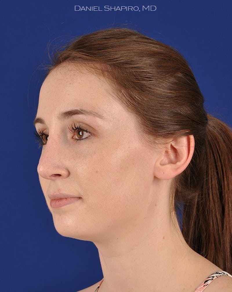 Female Rhinoplasty Before & After Gallery - Patient 17363952 - Image 4