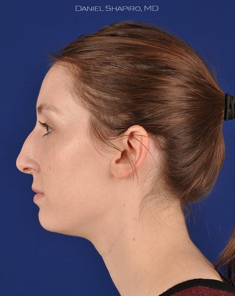 Female Rhinoplasty Before & After Gallery - Patient 17363952 - Image 5