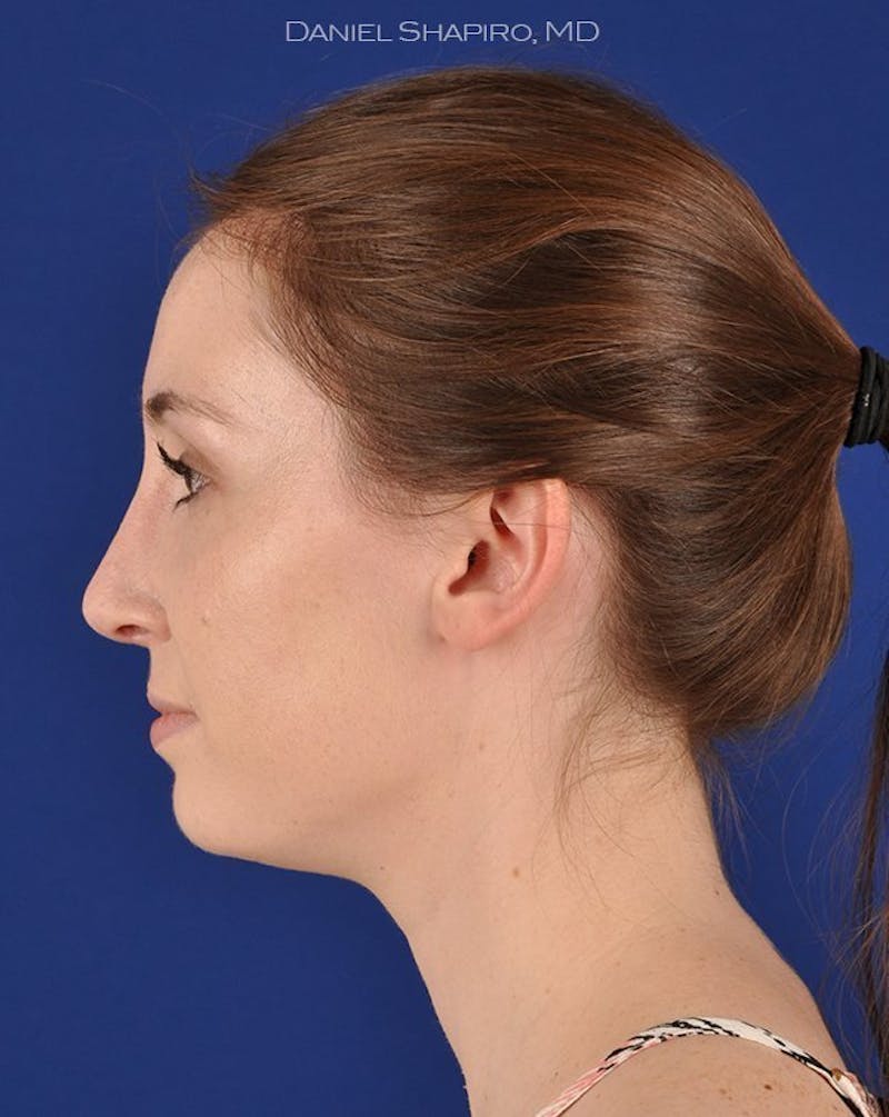 Female Rhinoplasty Before & After Gallery - Patient 17363952 - Image 6