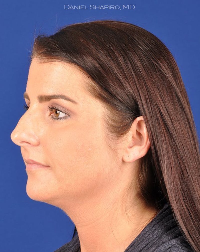 Female Rhinoplasty Before & After Gallery - Patient 17363954 - Image 3