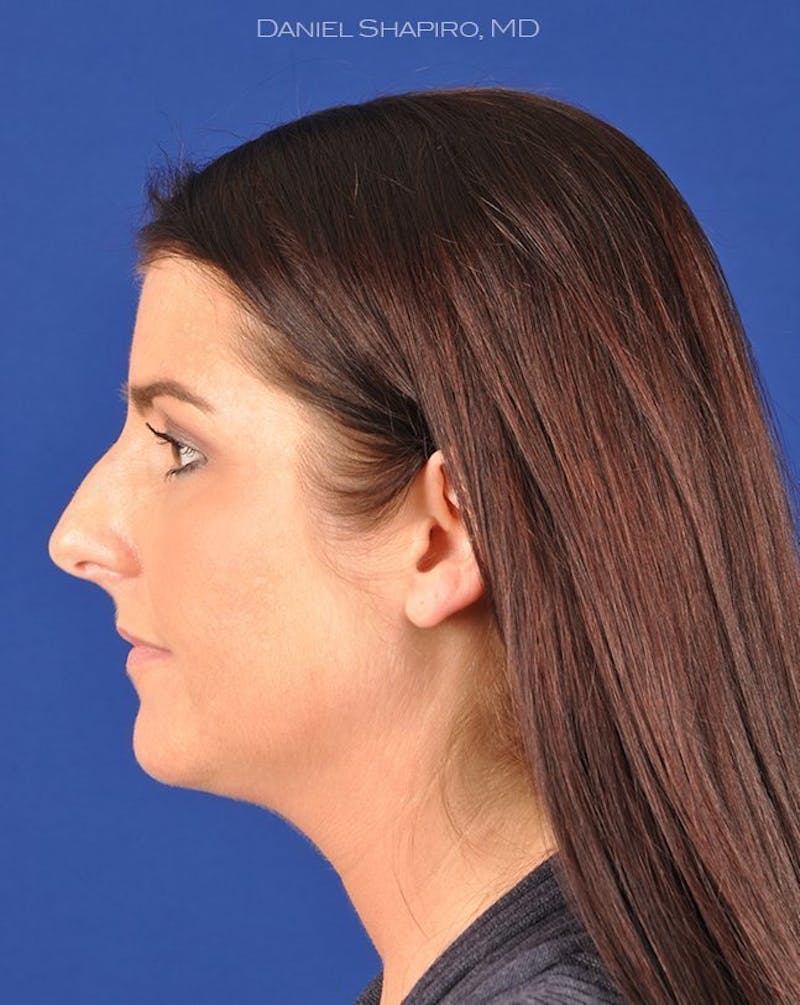 Female Rhinoplasty Before & After Gallery - Patient 17363954 - Image 5