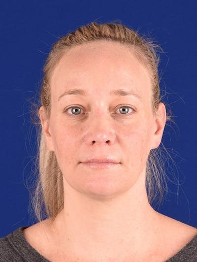 Female Rhinoplasty Before & After Gallery - Patient 17363955 - Image 2