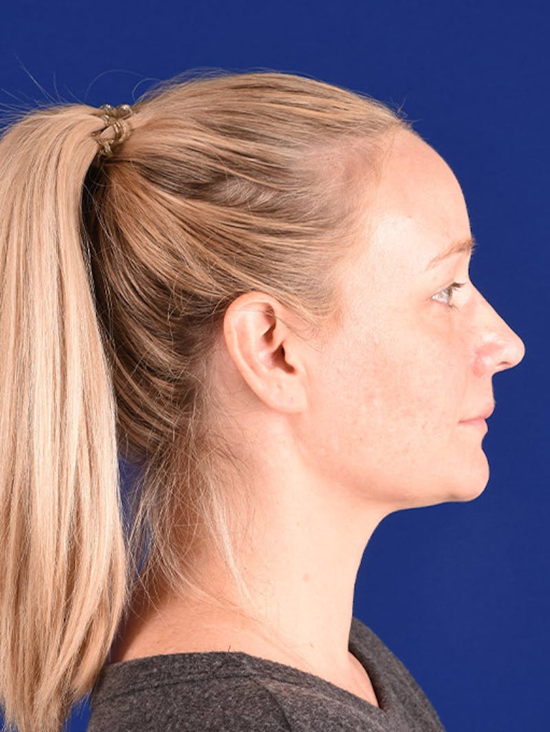 Female Rhinoplasty Before & After Gallery - Patient 17363955 - Image 6