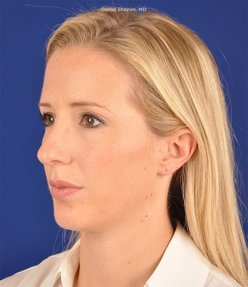 Female Rhinoplasty Before & After Gallery - Patient 17363956 - Image 3