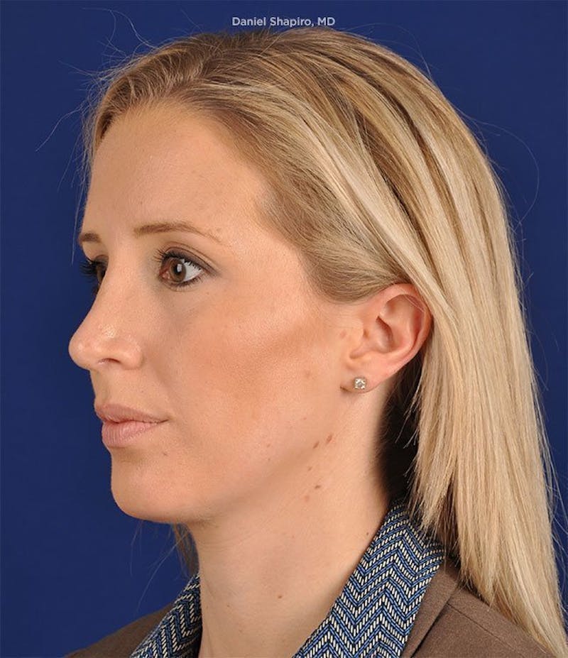 Female Rhinoplasty Before & After Gallery - Patient 17363956 - Image 4