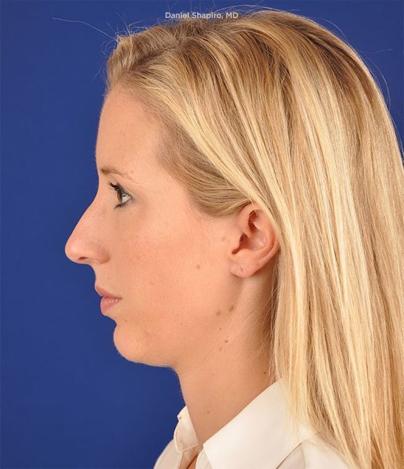 Female Rhinoplasty Before & After Gallery - Patient 17363956 - Image 5