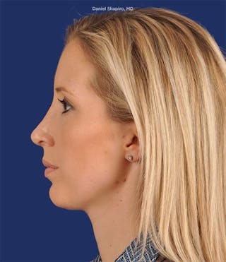 Female Rhinoplasty Before & After Gallery - Patient 17363956 - Image 6