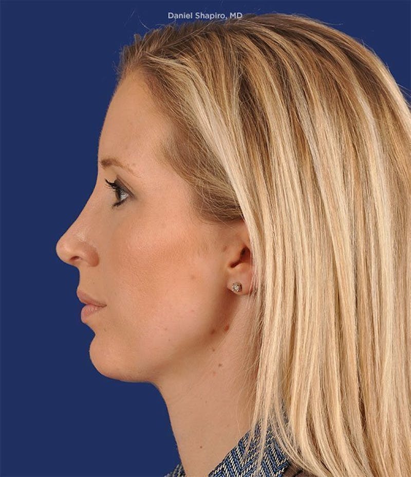 Female Rhinoplasty Before & After Gallery - Patient 17363956 - Image 6