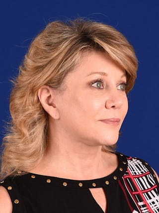 Female Rhinoplasty Before & After Gallery - Patient 17363958 - Image 4