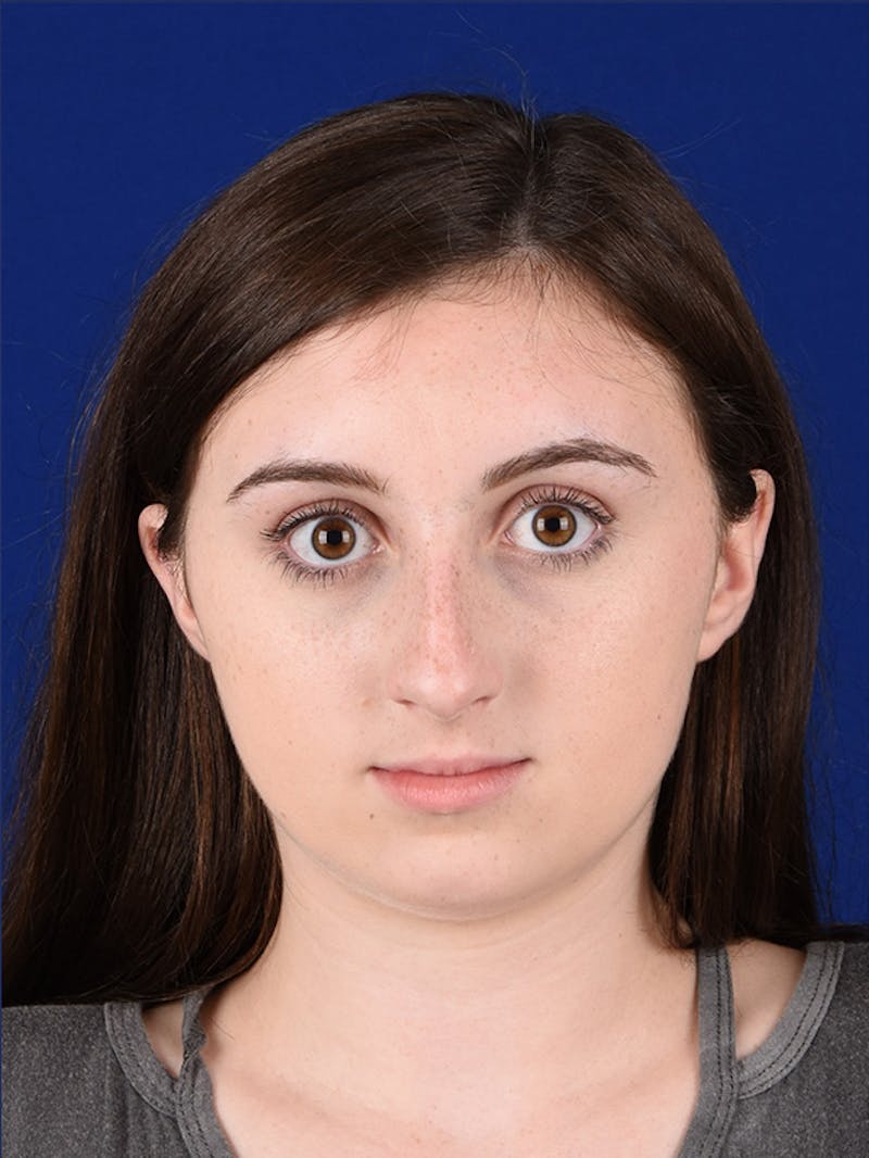 Female Rhinoplasty Before & After Gallery - Patient 17363960 - Image 1