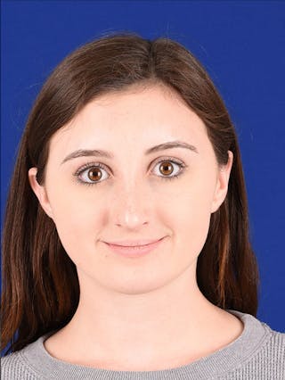 Female Rhinoplasty Before & After Gallery - Patient 17363960 - Image 2