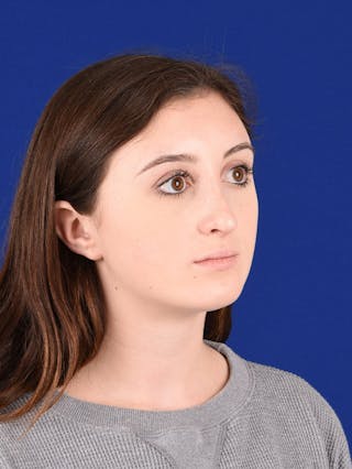 Female Rhinoplasty Before & After Gallery - Patient 17363960 - Image 4