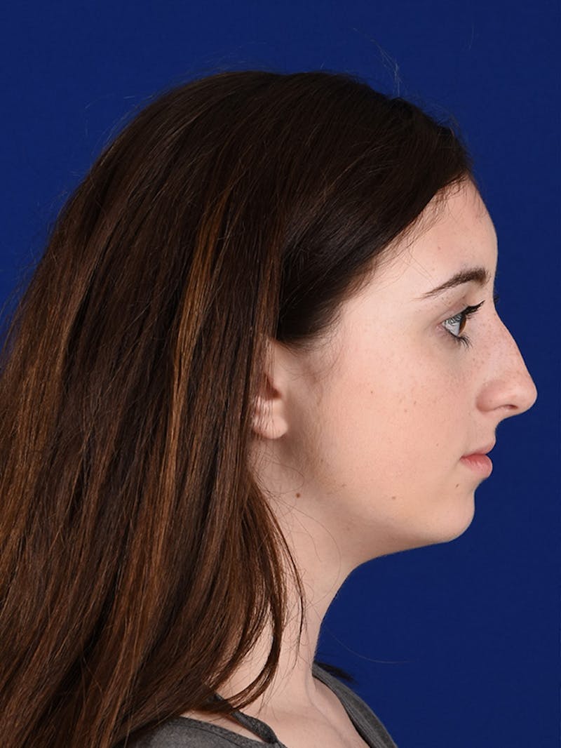 Female Rhinoplasty Before & After Gallery - Patient 17363960 - Image 5