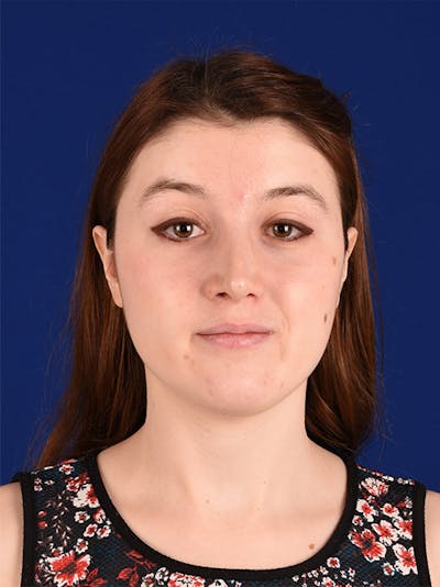 Female Rhinoplasty Before & After Gallery - Patient 17363963 - Image 2