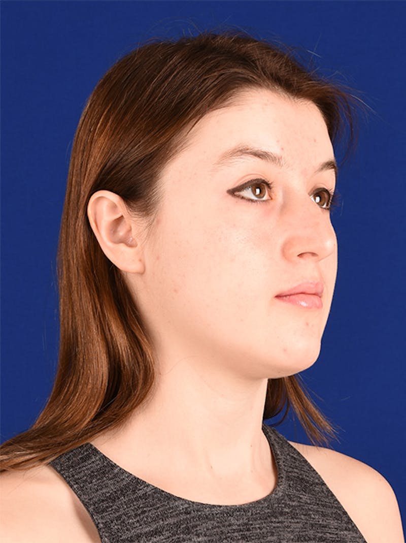 Female Rhinoplasty Before & After Gallery - Patient 17363963 - Image 3