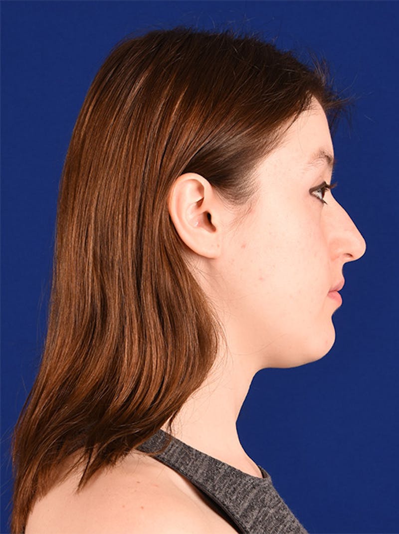 Female Rhinoplasty Before & After Gallery - Patient 17363963 - Image 5