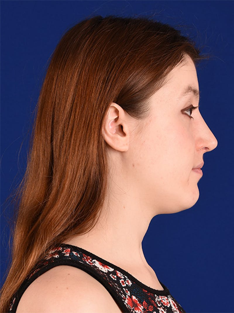 Female Rhinoplasty Before & After Gallery - Patient 17363963 - Image 6