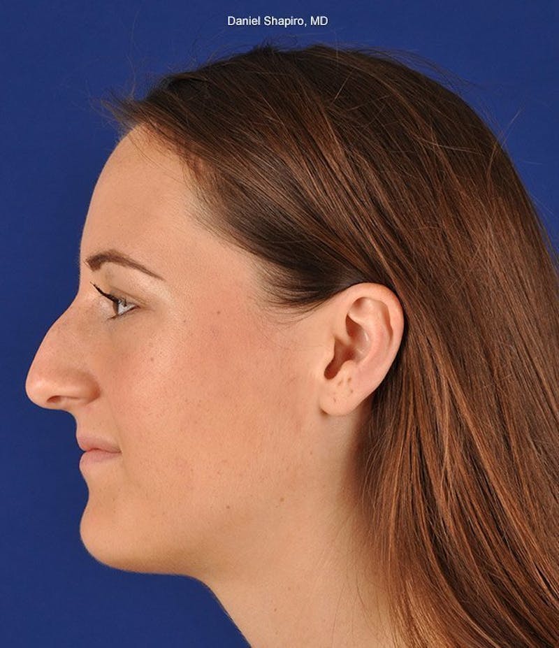 Female Rhinoplasty Before & After Gallery - Patient 17363975 - Image 5