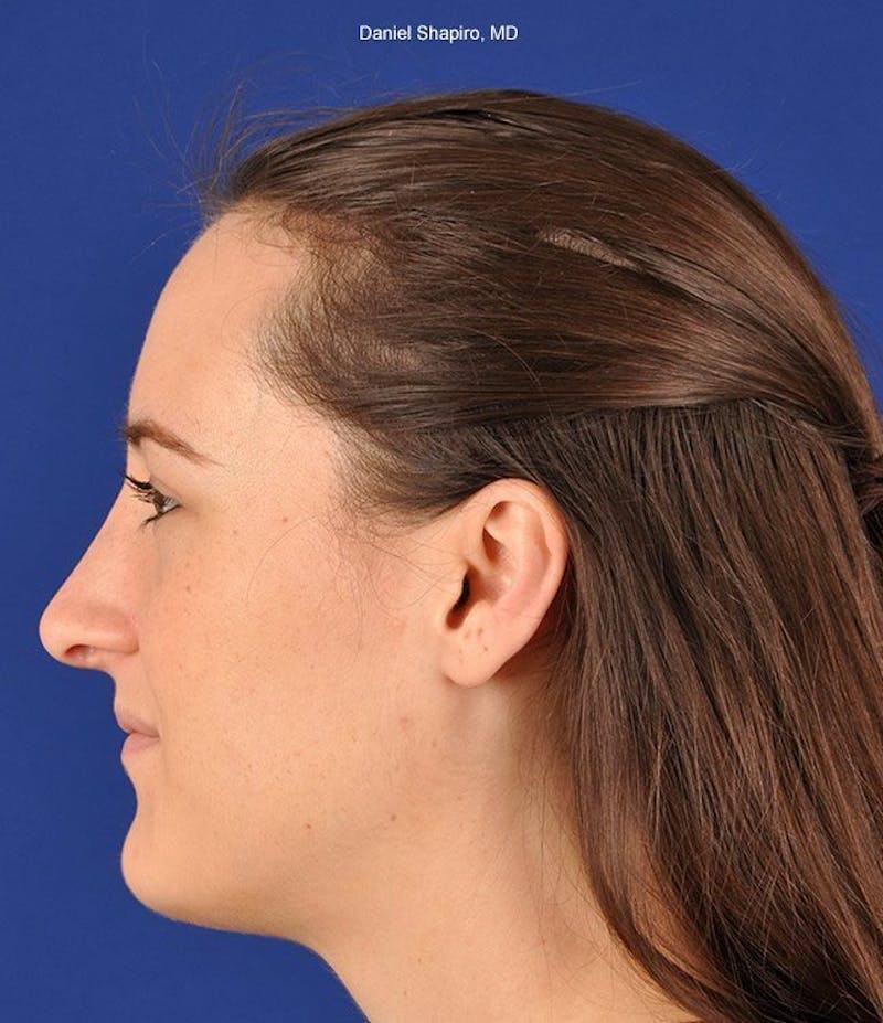 Female Rhinoplasty Before & After Gallery - Patient 17363975 - Image 6