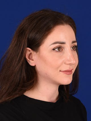 Female Rhinoplasty Before & After Gallery - Patient 17363979 - Image 4