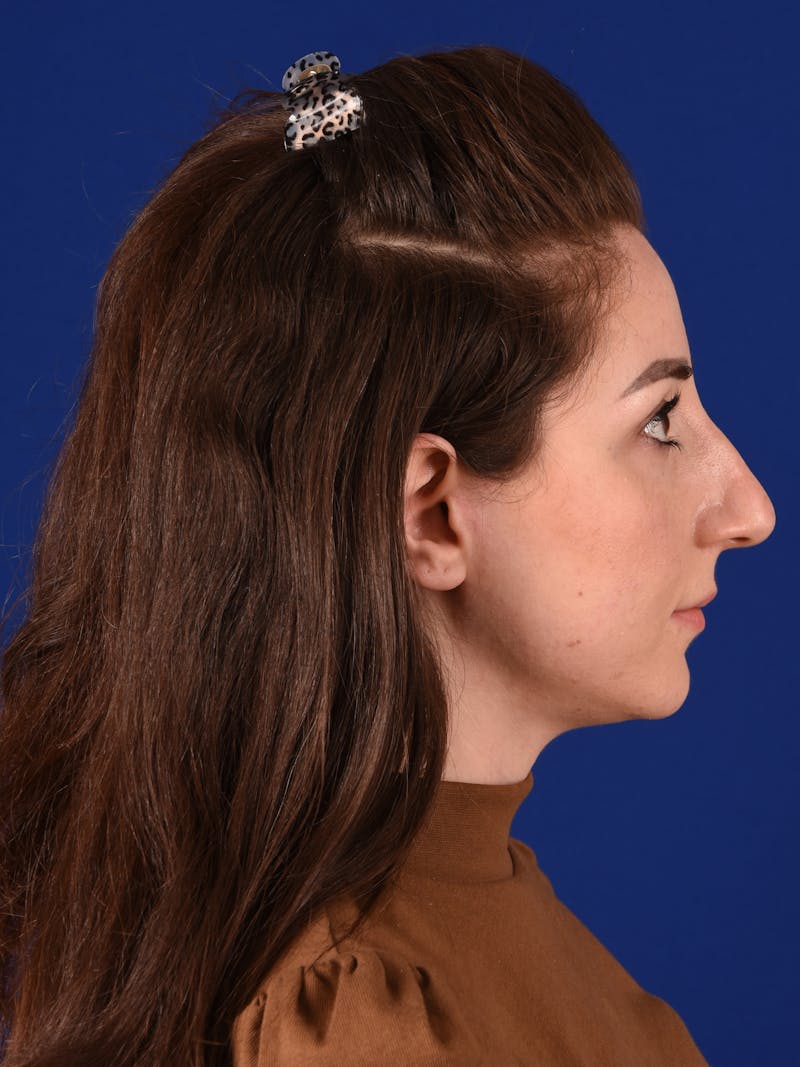 Female Rhinoplasty Before & After Gallery - Patient 17363979 - Image 5