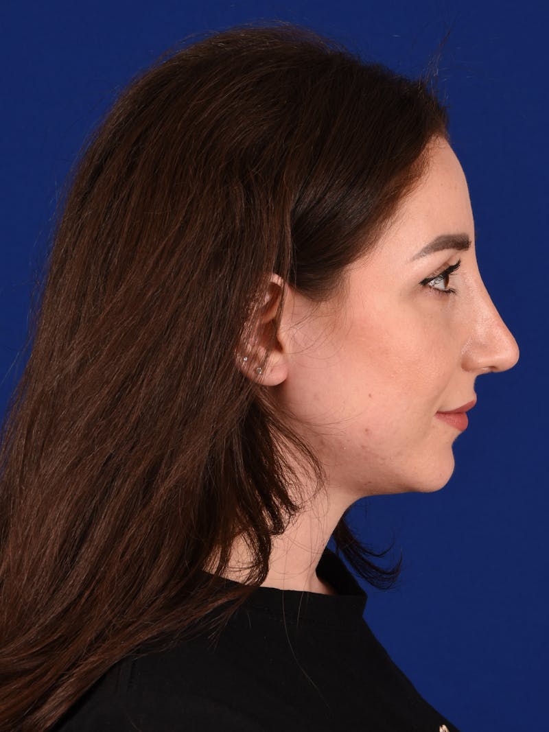 Female Rhinoplasty Before & After Gallery - Patient 17363979 - Image 6