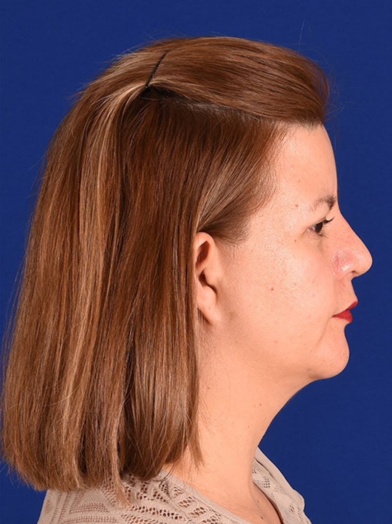 Female Rhinoplasty Before & After Gallery - Patient 17363982 - Image 6
