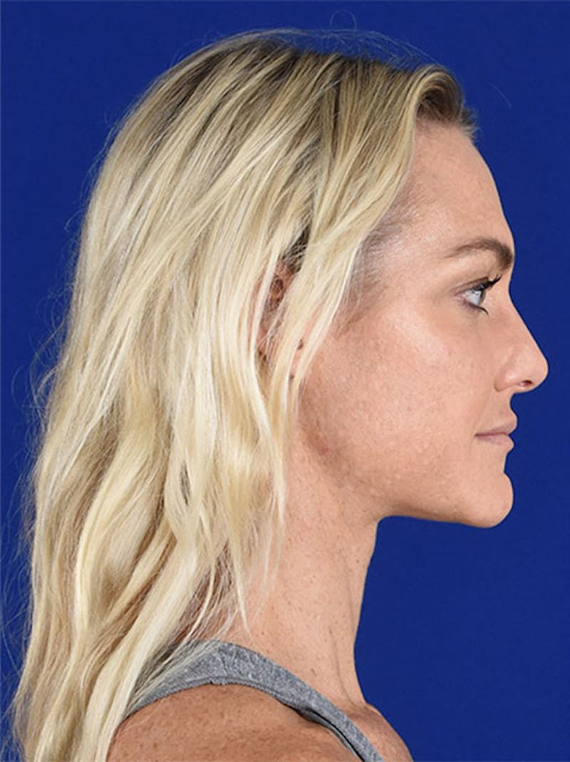 Female Rhinoplasty Before & After Gallery - Patient 17363985 - Image 5