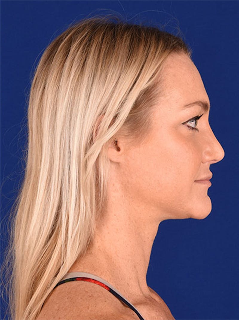 Female Rhinoplasty Before & After Gallery - Patient 17363985 - Image 6