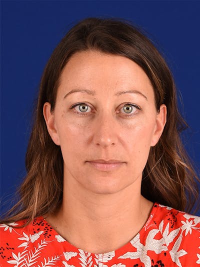 Female Rhinoplasty Before & After Gallery - Patient 17363987 - Image 1