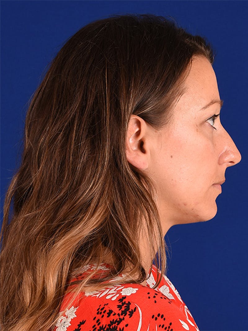 Female Rhinoplasty Before & After Gallery - Patient 17363987 - Image 5