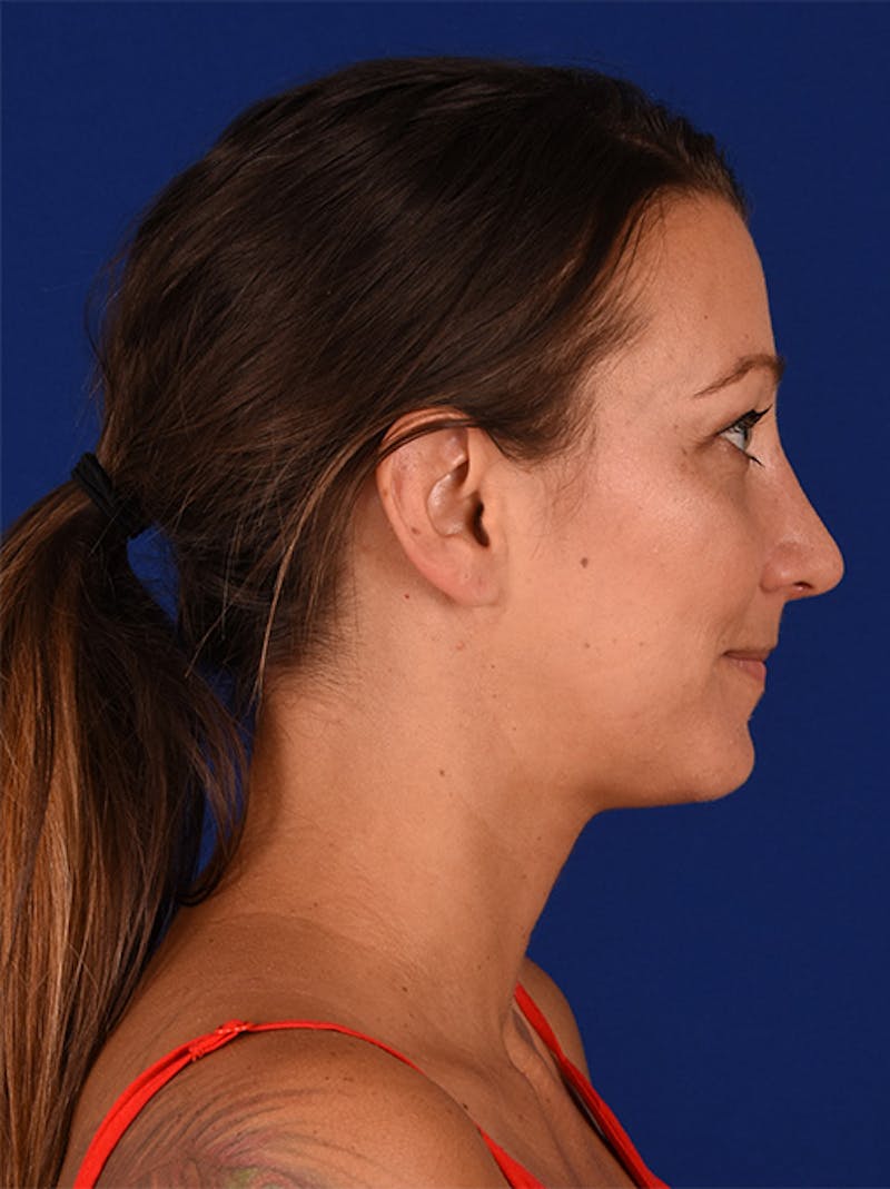 Female Rhinoplasty Before & After Gallery - Patient 17363987 - Image 6
