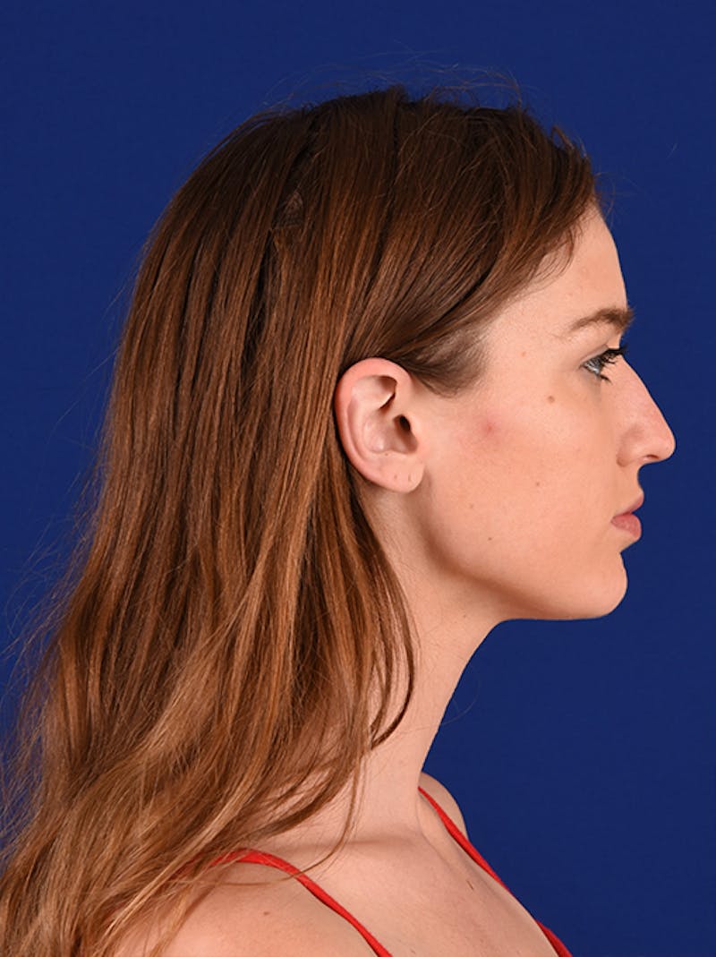 Female Rhinoplasty Before & After Gallery - Patient 17363989 - Image 5